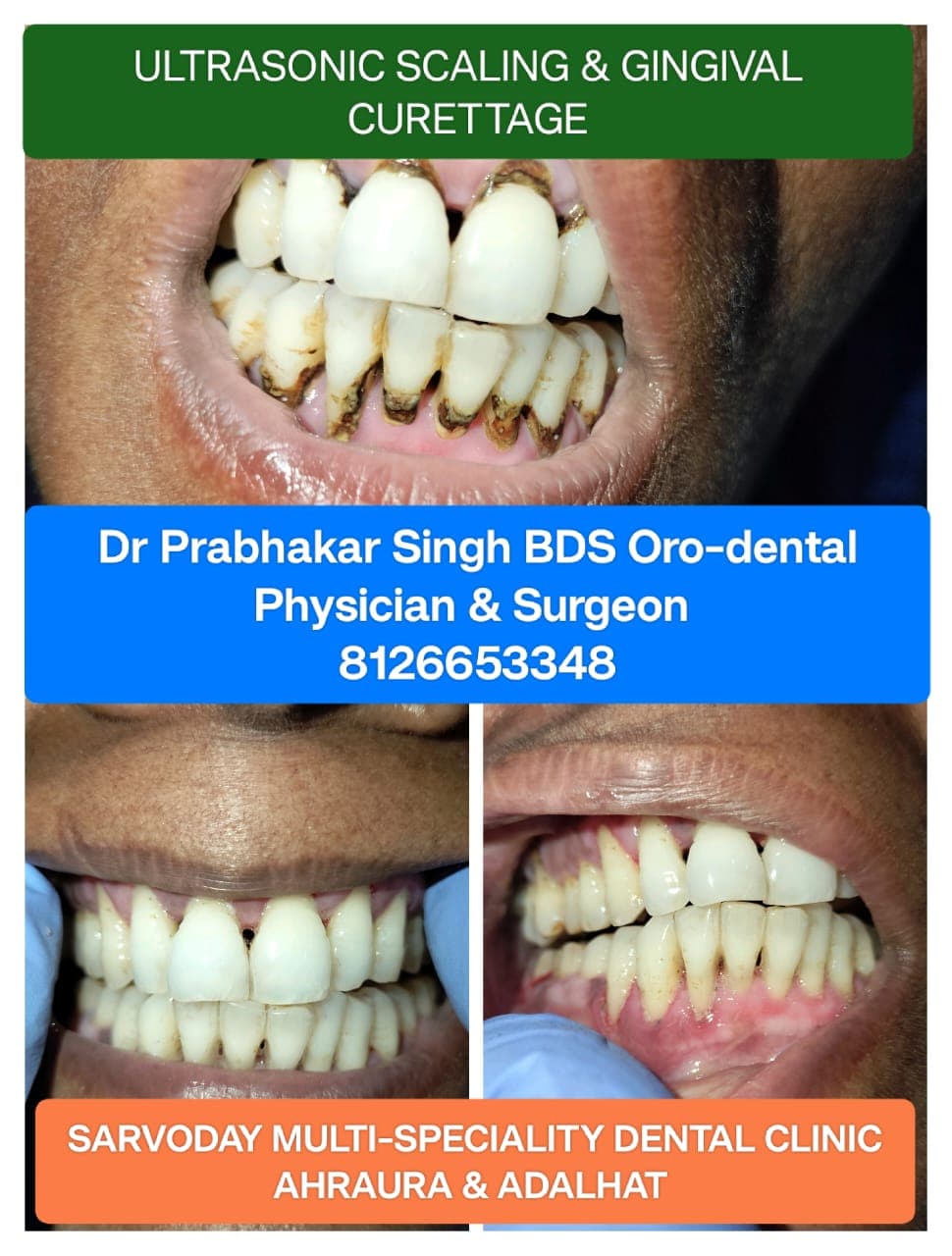 Teeth Whitening