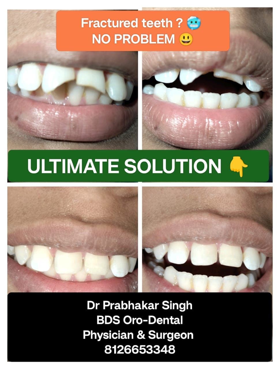 Teeth Whitening