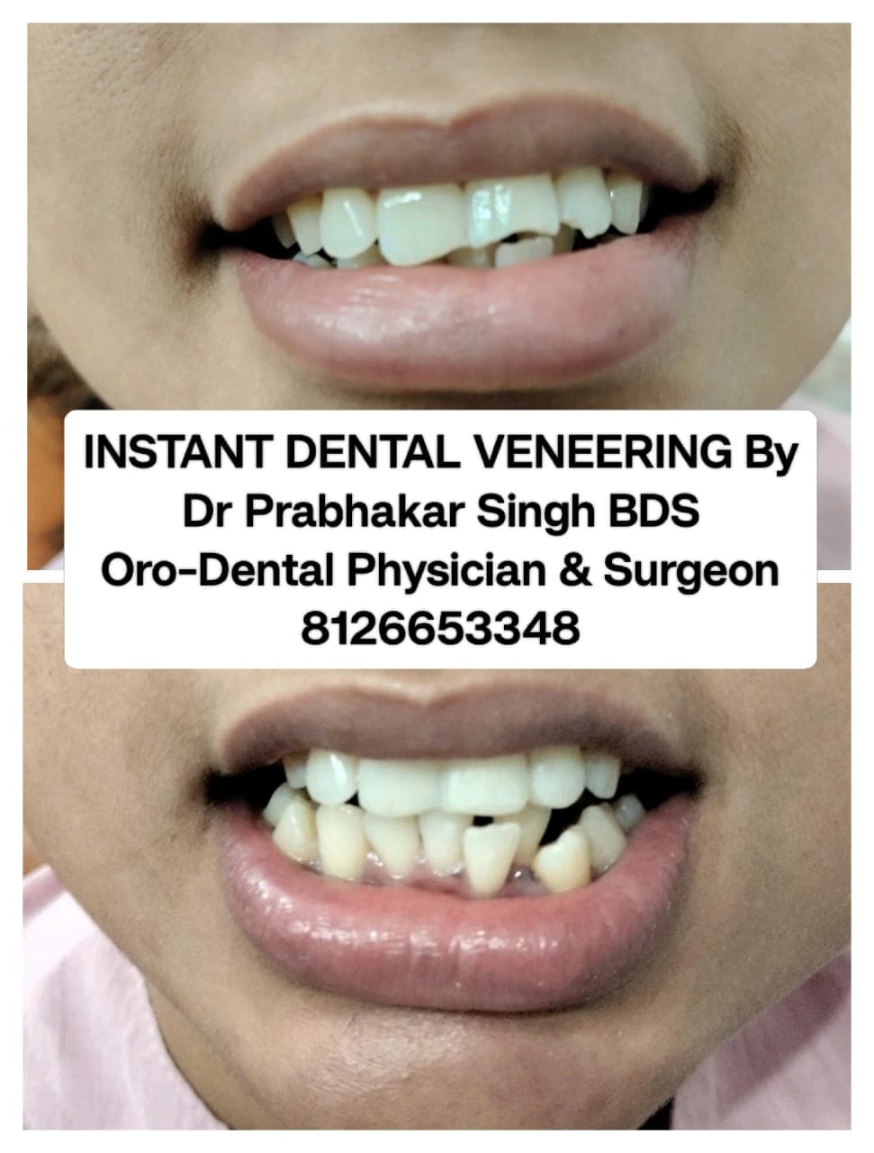Teeth Whitening