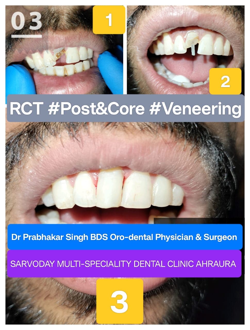 Teeth Whitening