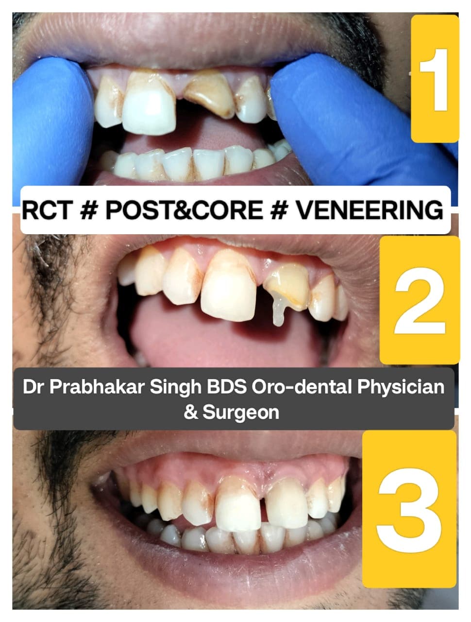 Teeth Whitening